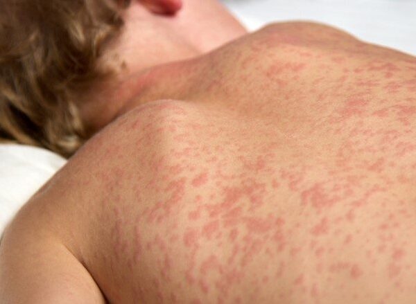 Busca ativa por casos de sarampo é intensificada&hellip;