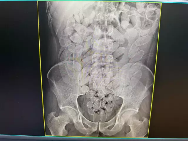 Bolivianos são flagrados com 645 cápsulas de cocaína no estômago